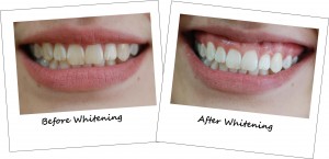 Cosmetic Dentistry -teeth-whitening before and after