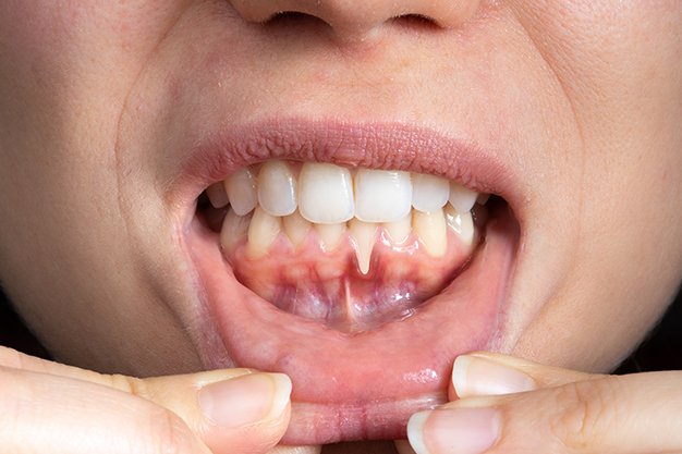 symptoms of receding gums